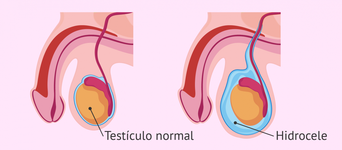 Hidrocele